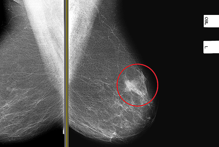 The Facts About Mammograms