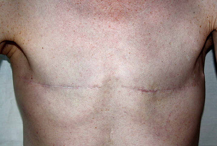 Double mastectomies for men with breast cancer on the rise