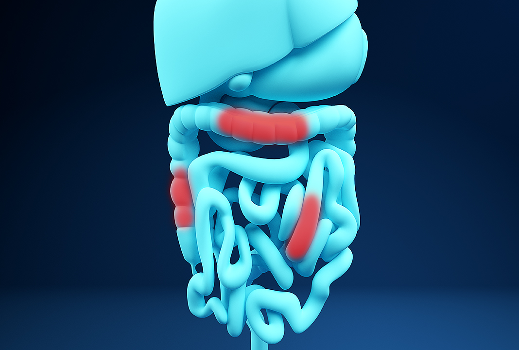 Crohn's disease is an inflammatory bowel disease - Mayo Clinic News Network