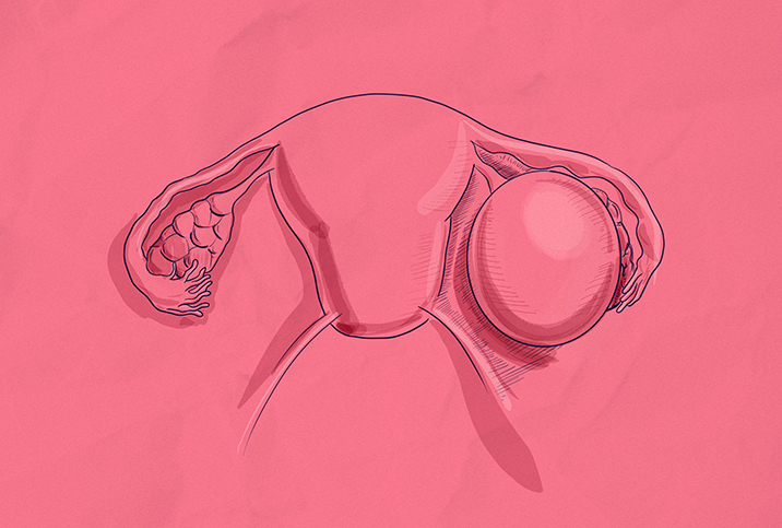 What Happens When an Ovarian Cyst Ruptures?