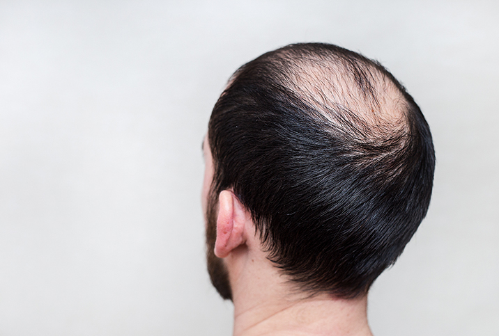 The Hair-Raising Issue of Thinning Hair