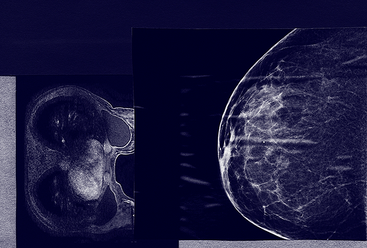 Mammogram or MRI: Which One Should You Choose?
