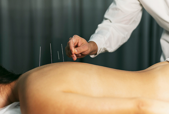 A-woman-lays-down-receiving-acupuncture