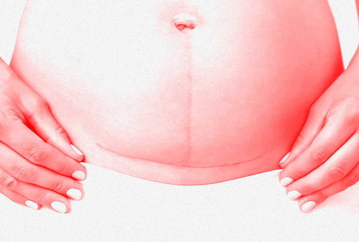 Your Burning C-Section Questions Answered