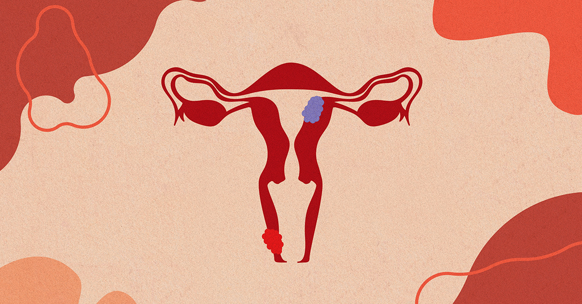 What's the Difference Between Cervical Cancer and Uterine Cancer?