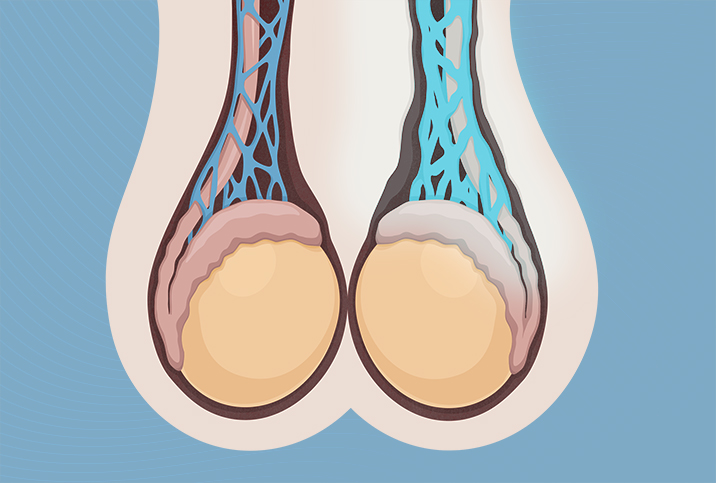 There Are Microsurgical Options for Varicocele Treatment