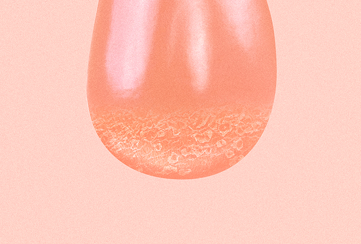 Scrotal cellulitis on the bottom of a testicle.