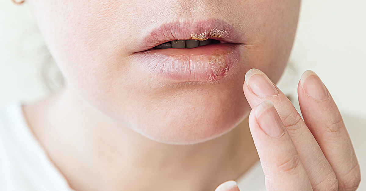 What A Herpes Outbreak Looks Like For Women