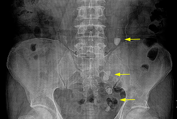 nephrolithiasis x ray