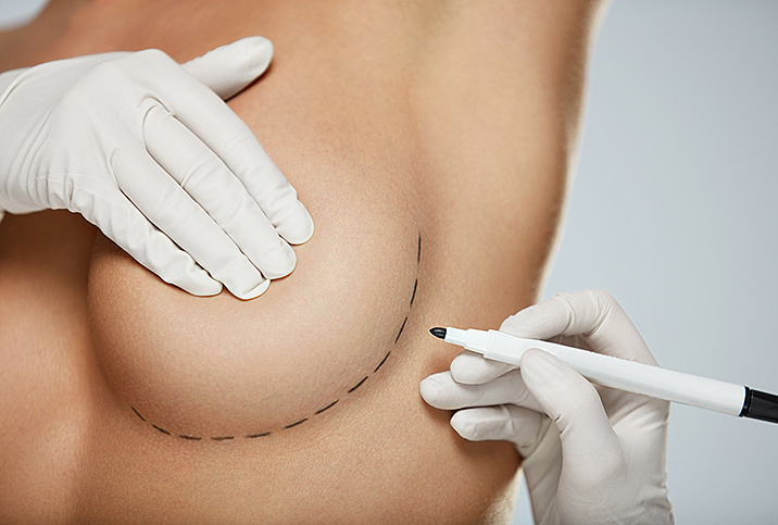 Oncoplastic Surgery, the New Frontier in Breast Reconstruction