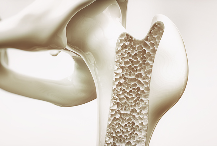 A cross section of the hip bone shows its density loss. 