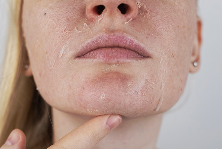 A pregnant woman is showing how the skin on her face is peeling.