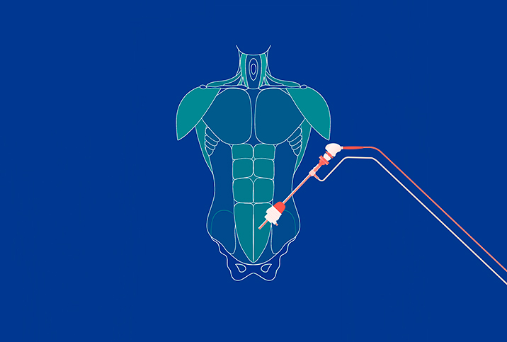 An outline of a male body from shoulders to pelvis has a robotic arm reaching towards the testicle area.