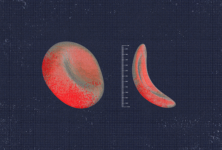 A healthy blood cell on the left is separated from a sickle cell on the right by a vertical ruler.