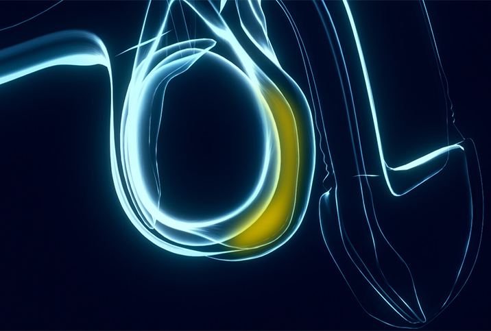 An x-ray of a testicle shows a hydrocele in yellow.