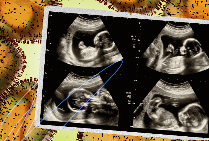 An ultrasound of a baby is laying on top of orange monkeypox virus cells.