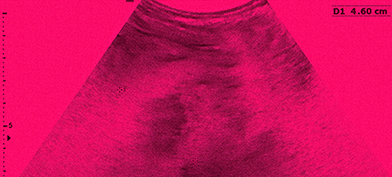 A sonogram from an ultrasound shows the uterus without a fetus.