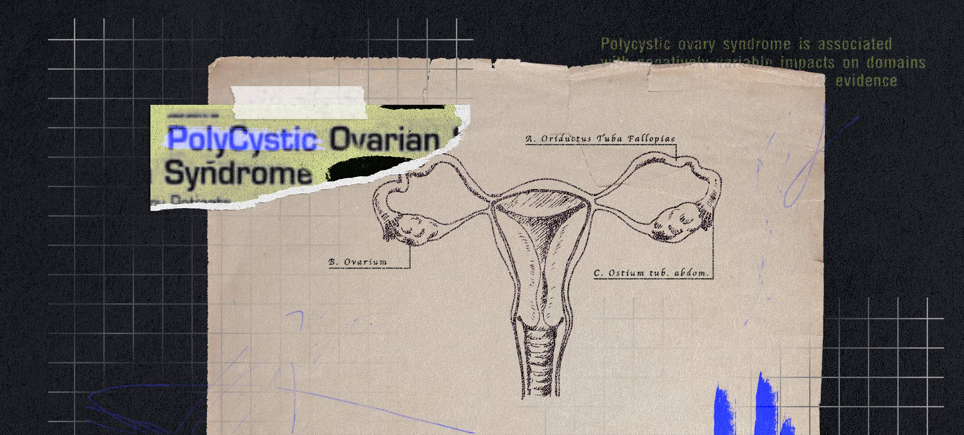 A textbook page with the female reproductive system has a newspaper clipping on top about PCOS.