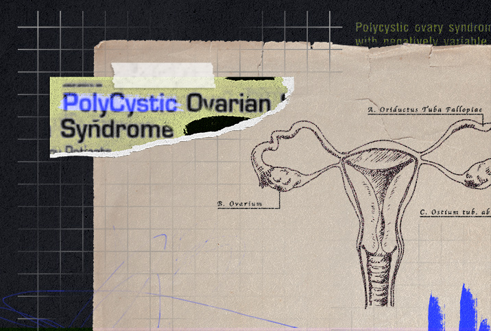 A textbook page with the female reproductive system has a newspaper clipping on top about PCOS.