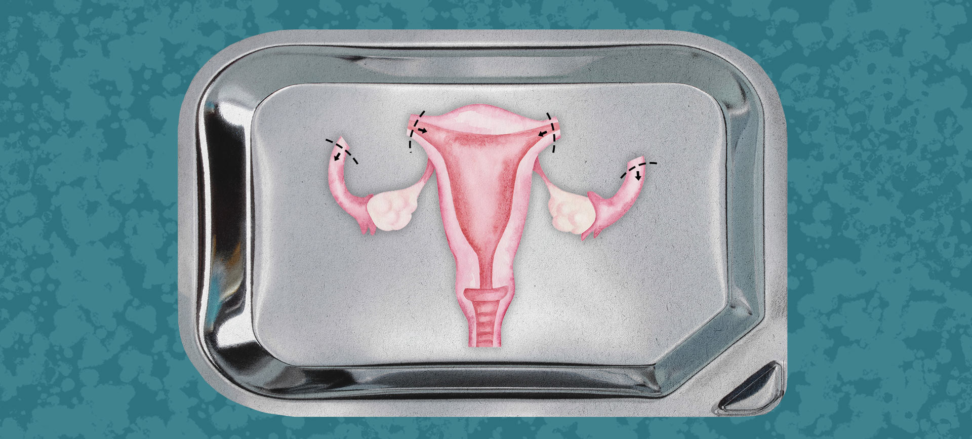 The female reproductive system is displayed on a medical tray with the fallopian tubes cut off.