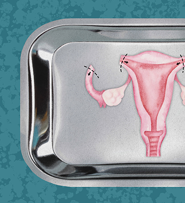 The female reproductive system is displayed on a medical tray with the fallopian tubes cut off.