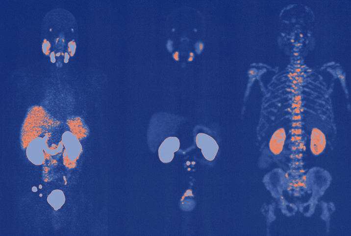 A blue x-ray from a PSMA PET scan is shown detecting prostate cancer in orange.
