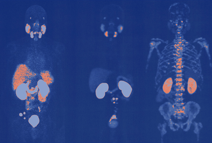 A blue x-ray from a PSMA PET scan is shown detecting prostate cancer in orange.