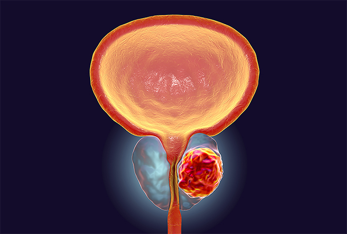 A male prostate glows in orange against a dark blue background.