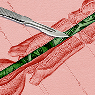 A diagrammed cross section of a penis has green money in place of the vas deferens and a scalpel lying across the image..
