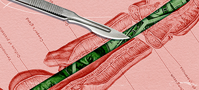 A diagrammed cross section of a penis has green money in place of the vas deferens and a scalpel lying across the image..