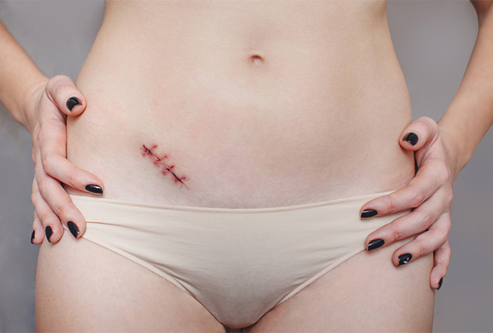 A person in underwear has their hands on their hips and a diagonal stitched up scar under their belly button.