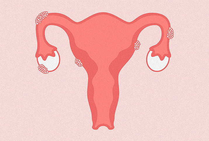 A pink female reproductive system has clumps of cells growing on the outside.