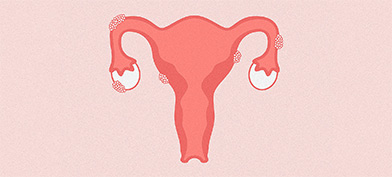 A pink female reproductive system has clumps of cells growing on the outside.