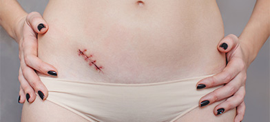 A person in underwear has their hands on their hips and a diagonal stitched up scar under their belly button.