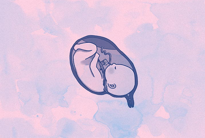 On a pink and blue cloudy background an upside down baby is curled in a uterus with the umbilical chord wrapped around its neck.