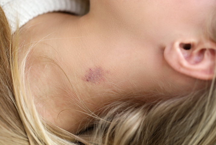A blonde woman lays down with a hickey on her neck.
