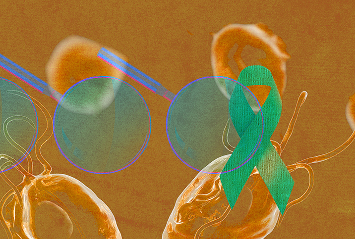 A blue magnifying looks over a yellow-orange prostate with a green cancer ribbon on it. 