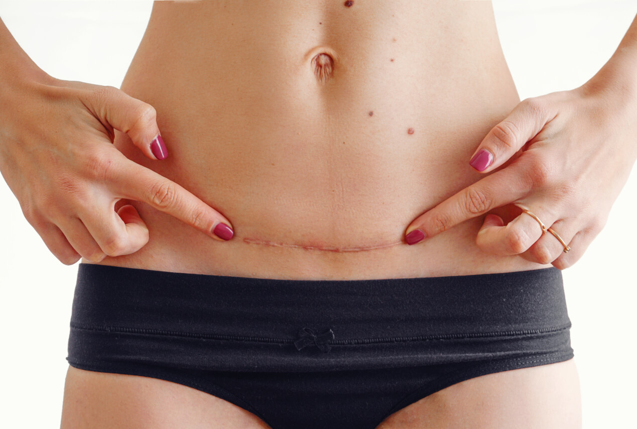 A woman points to her c-section scar as she stands in black underwear briefs.