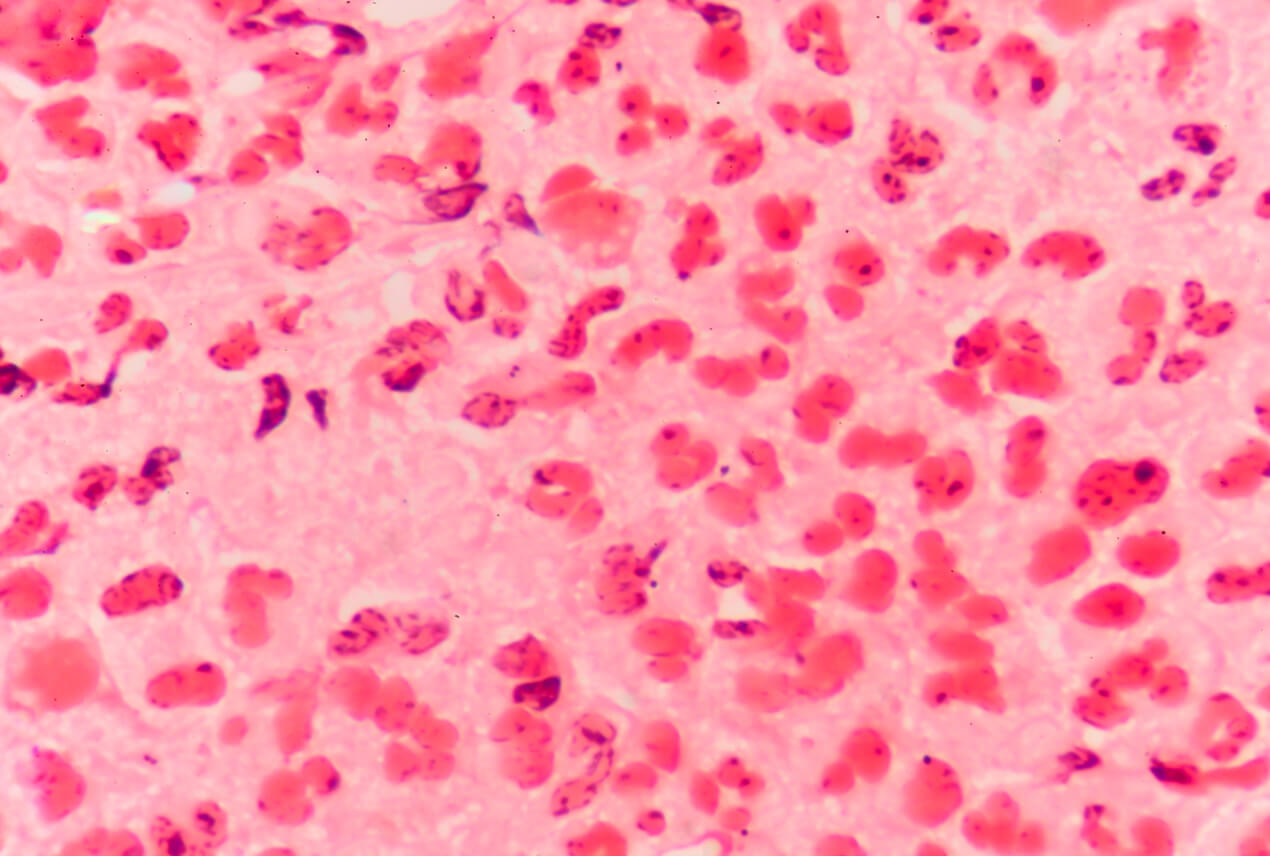 Gonorrhea cells are magnified in pink.