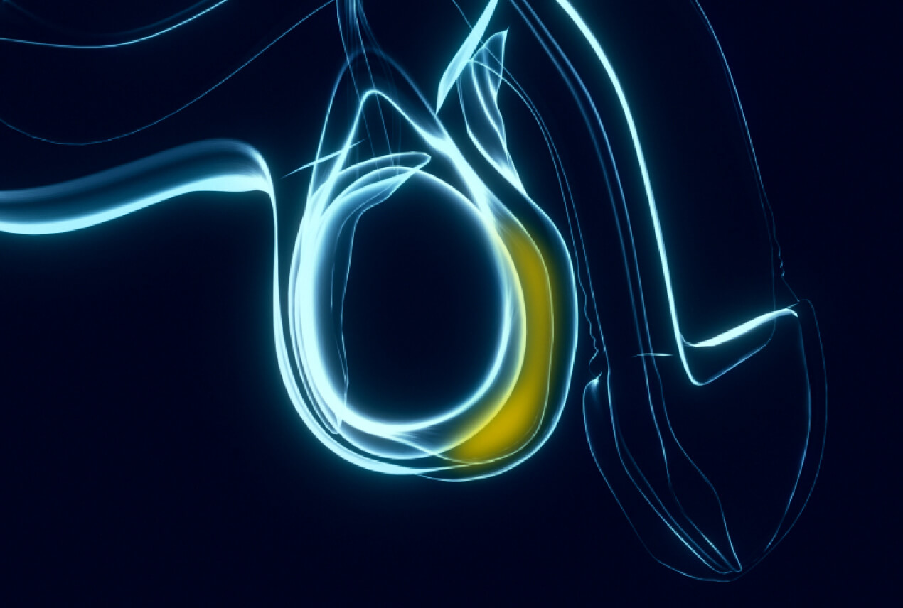 An x-ray of a testicle shows a hydrocele in yellow.
