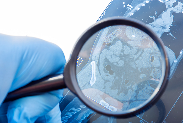 A hand holding a magnifying glass up to an Xray of an abdomen.