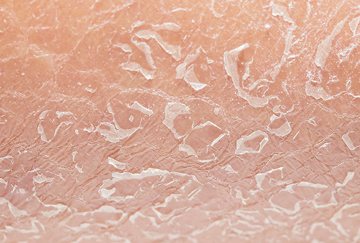 Atopic dermatitis on a person's skin.