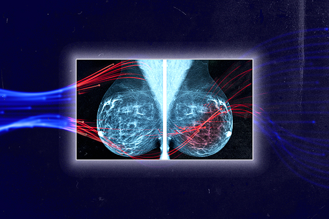 An medical scan of breasts has a series of red curved lines running through it.