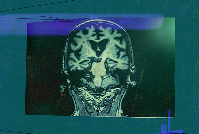 A green-tinted brain scan shows dark and light areas of the organ.