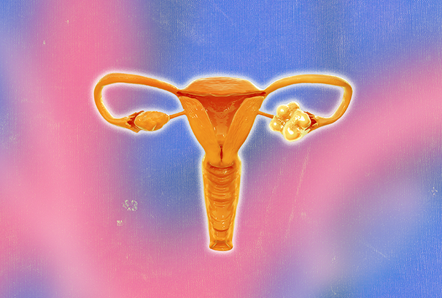 An orange female reproductive system has cysts on the right ovary.