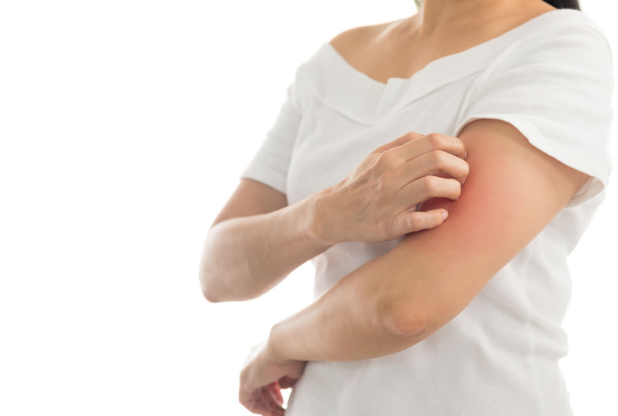 A person scratches their left upper arm and the skin is red.