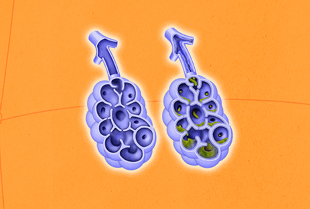 Two purple lungs are side-by-side against an orange background and one has green mucus in the alveoli.