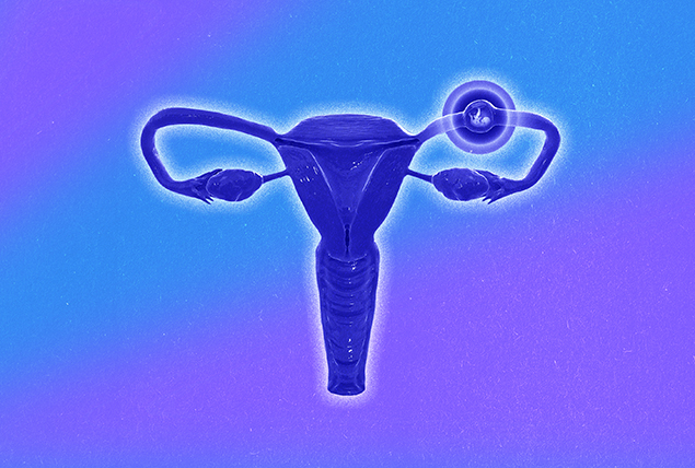 A purple female reproductive system has a bulging fallopian tube where an egg is implanted.