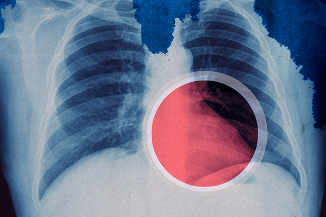 A large red dot highlights part of the lungs on an x-ray of a ribcage.