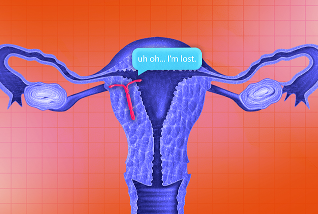 An IUD is lodged into the lining of the uterus with a chat bubble above it saying they are lost.